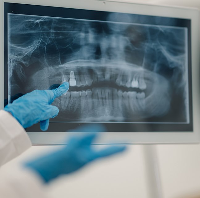 Digital X-ray(About Teeth) - Dr. Peter Igler, Claremont, CA