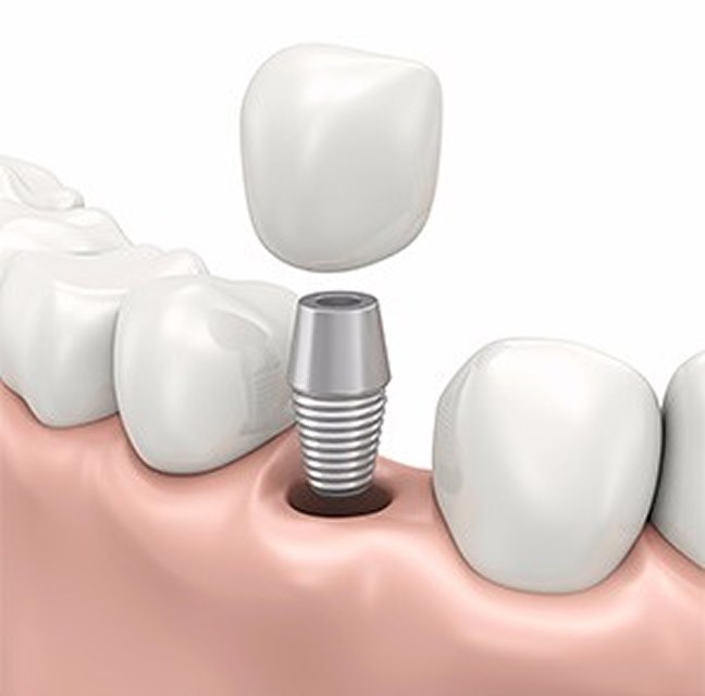 Implant Dentistry - Dr. Peter Igler, Claremont, CA