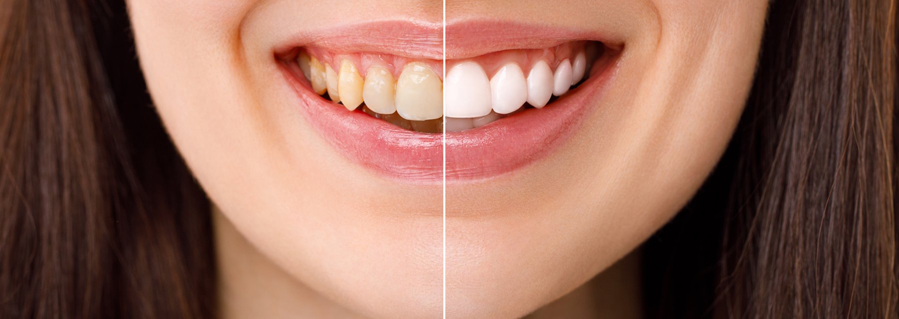 Before & After Photo - Dr. Peter Igler, Claremont, CA