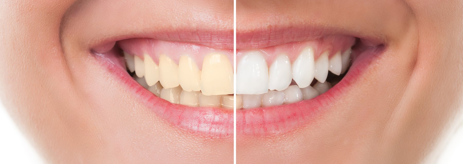 Before & After Photo - Dr. Peter Igler, Claremont, CA